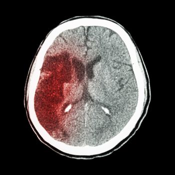 CT brain : show Ischemic stroke (hypodensity at right frontal-parietal lobe)