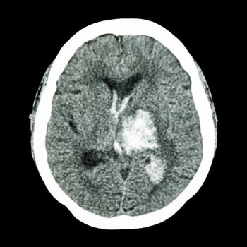 CT brain : show left thalamic hemorrhage (Hemorrhagic stroke)