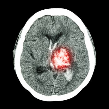 CT brain : show left thalamic hemorrhage (Hemorrhagic stroke)