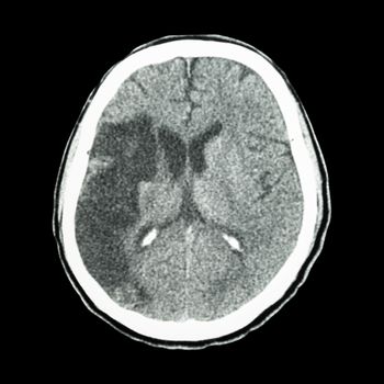 CT brain : show Ischemic stroke (hypodensity at right frontal-parietal lobe)