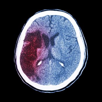 CT brain : show Ischemic stroke (hypodensity at right frontal-parietal lobe)