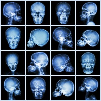 Collection x-ray skull (asian people)