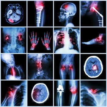 Set of X-ray multiple part of human,Multiple disease,orthopedic,surgery (Stroke,Bone fracture,Orthopedic operation,Kidney stone,Arthritis,Gout,Pulmonary tuberculosis,Heart disease,Scoliosis,etc)