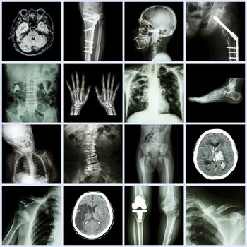 Set of X-ray multiple part of human,Multiple disease,orthopedic,surgery (Stroke,Bone fracture,Orthopedic operation,Kidney stone,Arthritis,Gout,Pulmonary tuberculosis,Heart disease,Scoliosis,etc)