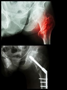 Intertrochanteric fracture left femur (fracture thigh's bone). It was operated and inserted intramedullary nail.