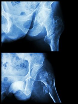 Fracture head of femur(Thigh bone) (intertrochanteric fracture) (2 position)