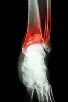 film x-ray ankle show fracture distal tibia and fibula (leg's bone)