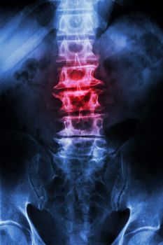 "Spondylosis" film x-ray L-S spine (lumbar-sacrum) of old aged patient and inflammation at spine