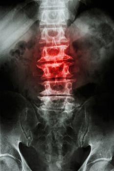 "Spondylosis" film x-ray L-S spine (lumbar-sacrum) of old aged patient and inflammation at spine