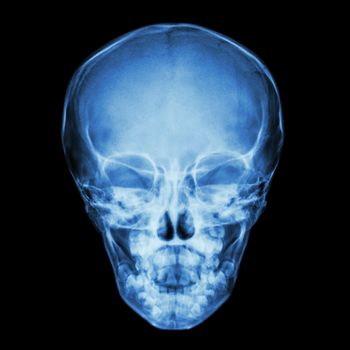 film x-ray skull AP : show normal thai child's skull