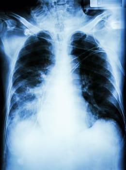 "Pneumonia with respiratory failure" film chest x-ray of patient with endotracheal tube,catheter. he was treated in ICU.