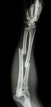 fracture shaft of radius & ulnar bone