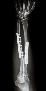 fracture shaft of radius & ulnar bone. It was operated and internal fixed by plate and screw