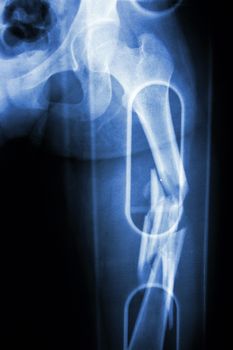 Film X-ray show comminute fracture shaft of femur (thigh bone). It was spliced