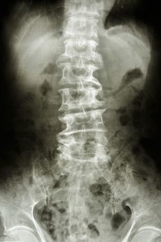 film X-ray show bent lumbar spine and spurs of old people (spondylosis patient) , (spine )