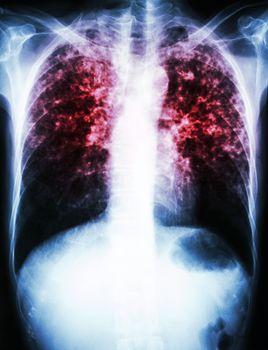 film chest x-ray show interstitial infiltrate both lung due to Mycobacterium tuberculosis infection (Pulmonary Tuberculosis)