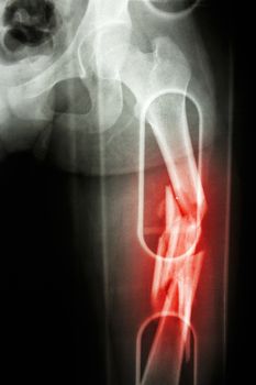 Film X-ray show comminute fracture shaft of femur (thigh bone). It was spliced
