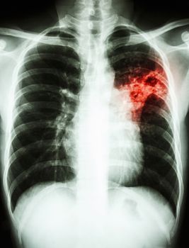 film chest x-ray show alveolar infiltrate at left middle lung due to Mycobacterium tuberculosis infection (Pulmonary Tuberculosis)