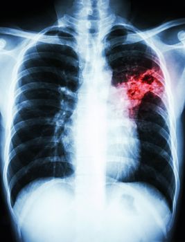 film chest x-ray show alveolar infiltrate at left middle lung due to Mycobacterium tuberculosis infection (Pulmonary Tuberculosis)