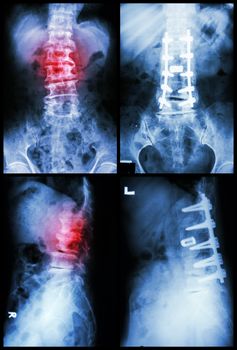 "Spondylosis and Spondylolisthesis" It was operated and internal fixed at spine (Left image : before operated) (Right image : after operated)