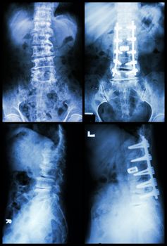 "Spondylosis and Spondylolisthesis" It was operated and internal fixed at spine (Left image : before operated) (Right image : after operated)