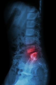 Lumbar spine of child and inflammation at lumbar spine ( low back pain ) ( X-ray thoracic - lumbar spine ) ( lateral view )
