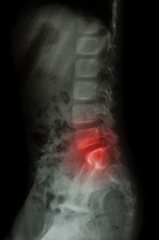 Lumbar spine of child and inflammation at lumbar spine ( low back pain ) ( X-ray thoracic - lumbar spine ) ( lateral view )