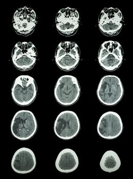 CT scan (computed tomography) of brain show cerebral infarction at right temporal-parietal lobe ( ischemic stroke )