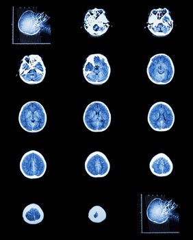 CT scan (computed tomography) of normal brain ( cerebrovascular system )