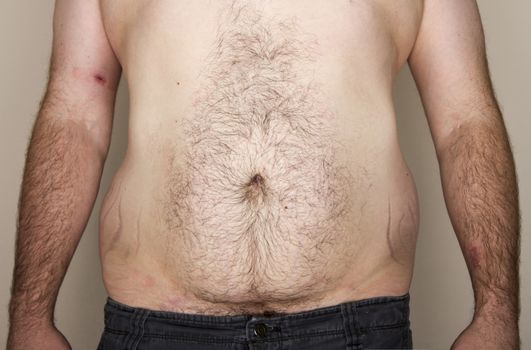 Midsection of an overweight obese male facing the camera