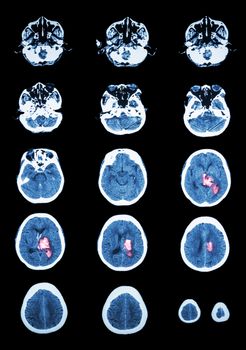 Hemorrhagic Stroke . CT scan (computed tomography) of brain ( cerebrovascular system ) : Intracerebral hemorrhage at left cerebral hemisphere