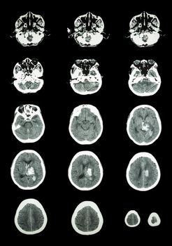 Hemorrhagic Stroke . CT scan (computed tomography) of brain ( cerebrovascular system ) : Intracerebral hemorrhage at left cerebral hemisphere