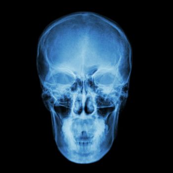 X-ray skull and Stroke ( cerebrovascular accident (CVA) )