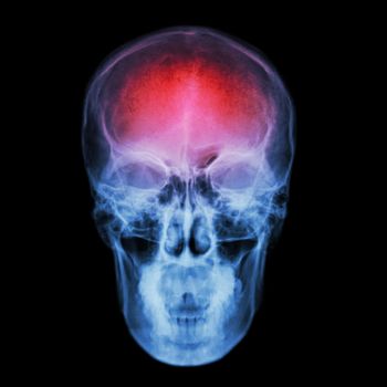 X-ray skull and Stroke ( cerebrovascular accident (CVA) )