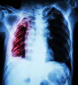 Pulmonary Tuberculosis . Chest X-Ray : Right lung atelectasis and infiltration and effusion due to Mycobacterium Tuberculosis infection