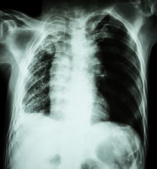 Pulmonary Tuberculosis . Chest X-Ray : Right lung atelectasis and infiltration and effusion due to Mycobacterium Tuberculosis infection