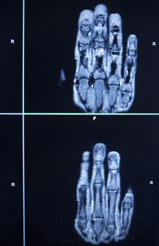 MRI magentic resonance imaging nuclear scanning scan test results hand fingers injury photo.