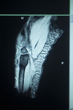 MRI magentic resonance imaging nuclear scanning scan test results tennis elbow arm injury photo.
