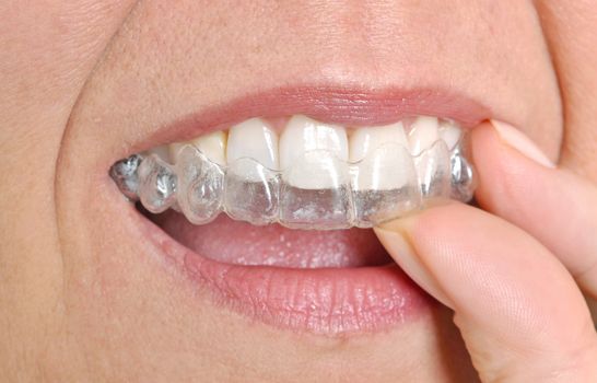 Woman putting in her invisible braces