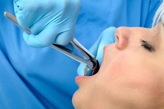 Dentist at work, tooth extraction using forceps