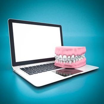 picture of dental braces on a blue background