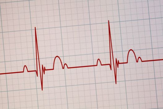 Flatline blip on a medical heart monitor ECG / EKG (electrocardiogram) with white background