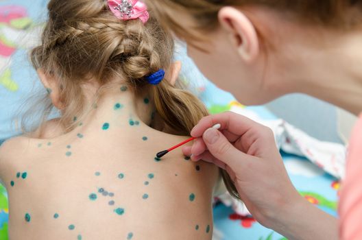Lubrication zelenkoj chickenpox sores on the back of a little girl