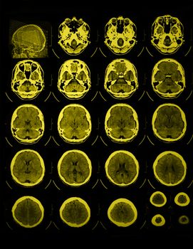 Photo of the CT and MRI of the skull