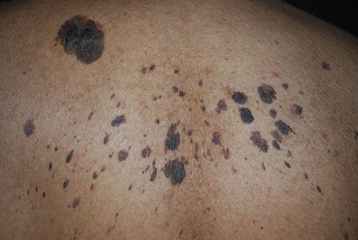 Cancerous moles on the back of a man.