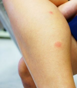 Human skin, presenting an allergic reaction, allergic rash at woman leg.                              