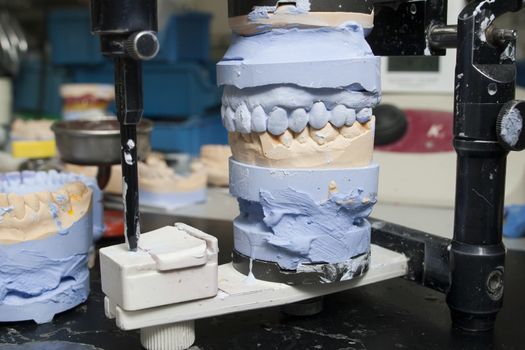 dental prosthesis in dental labratory