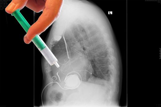 Radiograph left side of the chest. Vergößertes heart with implanted pacemaker system. Below are the pump of the heart assist system.