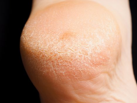 Closeup of cracked dry skin on heel isolated towards black