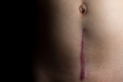 A recovering scar from a c-section operation dramatically faded to black.